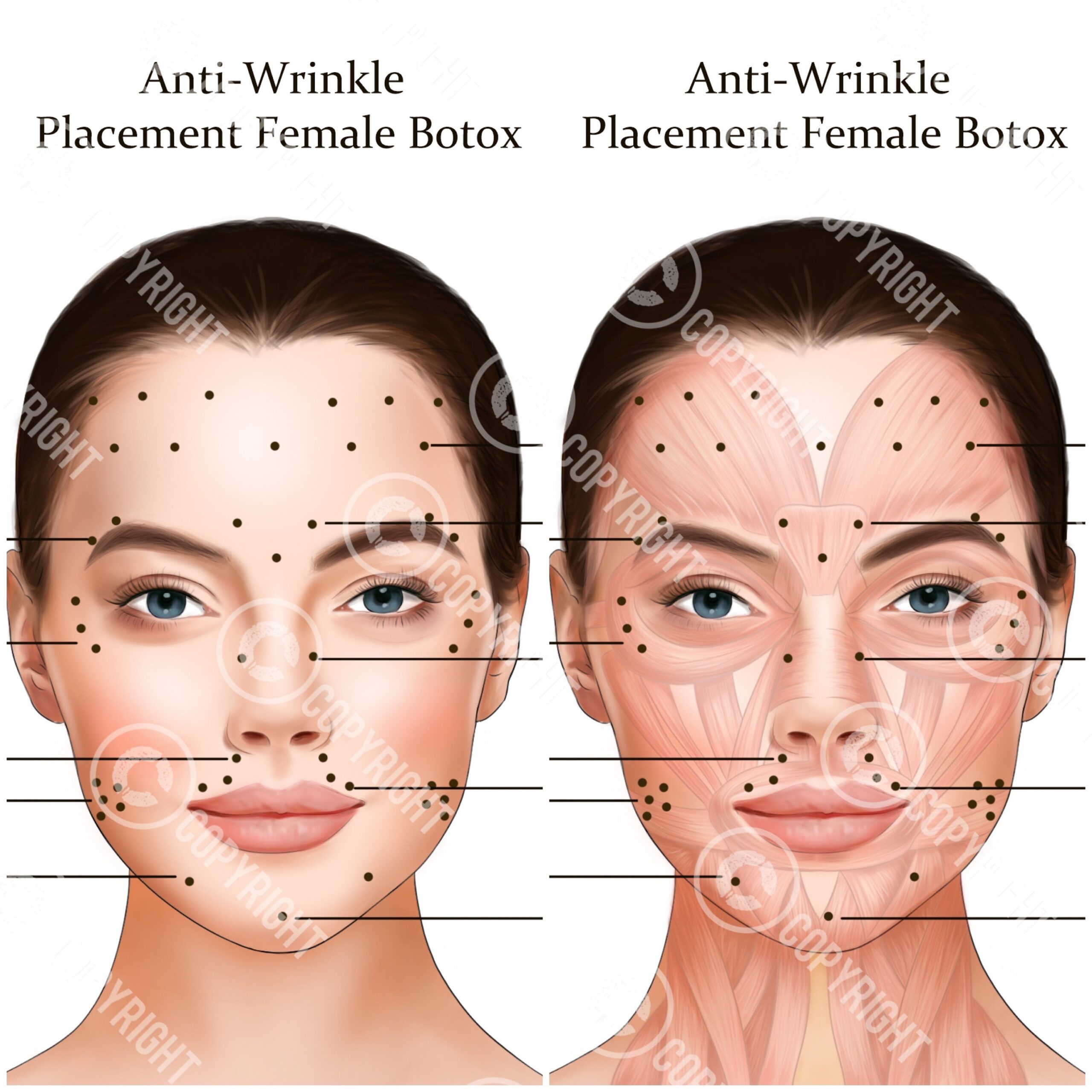 Printable Botox Injection Face Map Etsy UK